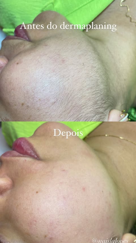 Dermaplaning Antes e Depois