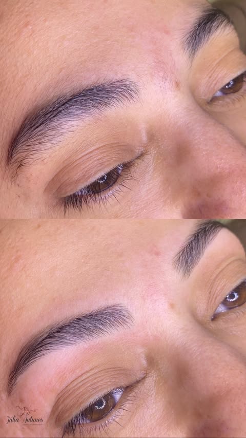 Resultado Dermaplaning