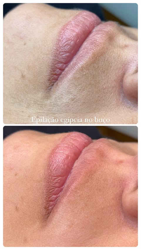 Epilação Egípcia no Buço